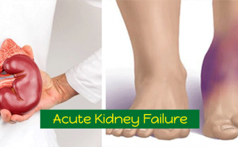 Acute-Kidney-Failure