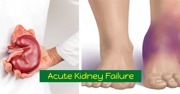 Acute-Kidney-Failure