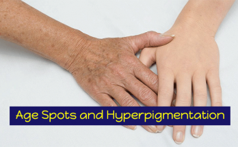 Age-Spots-and-Skin-Hyperpigmentation