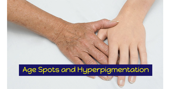 Age-Spots-and-Skin-Hyperpigmentation