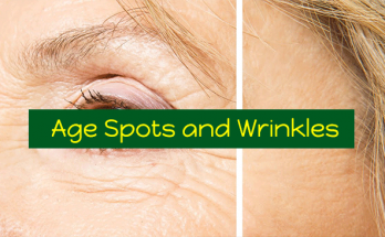Age-Spots-and-Wrinkles