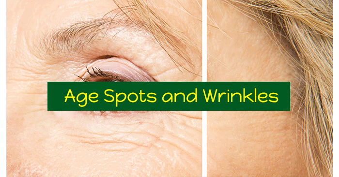 Age-Spots-and-Wrinkles