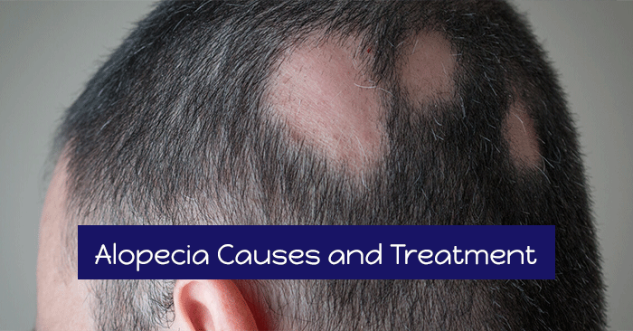 Alopecia Hair Loss Causes, Symptoms and Treatment with Home Remedies
