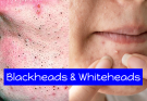 Blackheads-and-Whiteheads-Causes