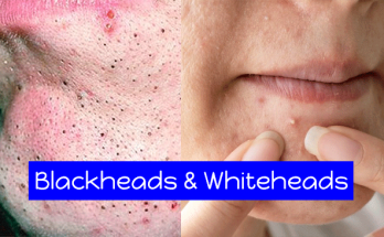 Blackheads-and-Whiteheads-Causes