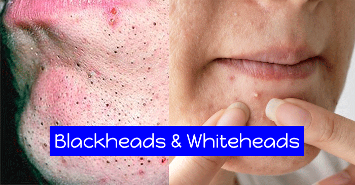 Blackheads-and-Whiteheads-Causes