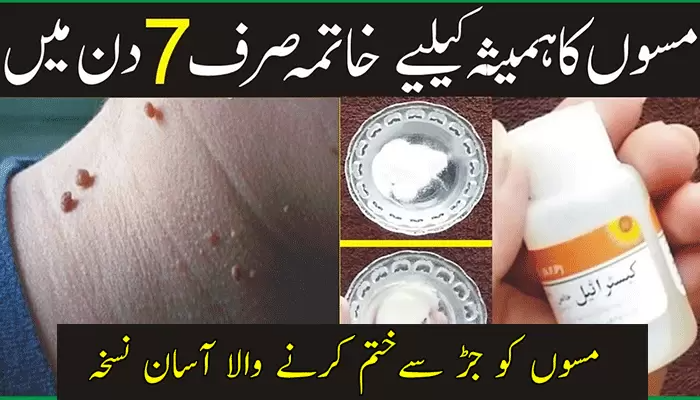 Skin Tag Removal Cream in Pakistan