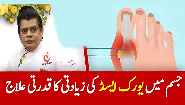 Uric-Acid-Treatment-in-Urdu-with-Home-Remedy
